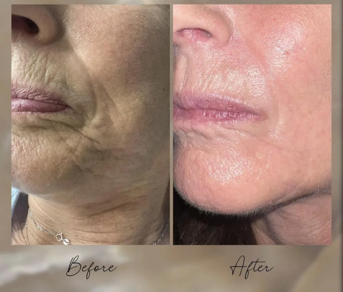 Inkless revision before and after result