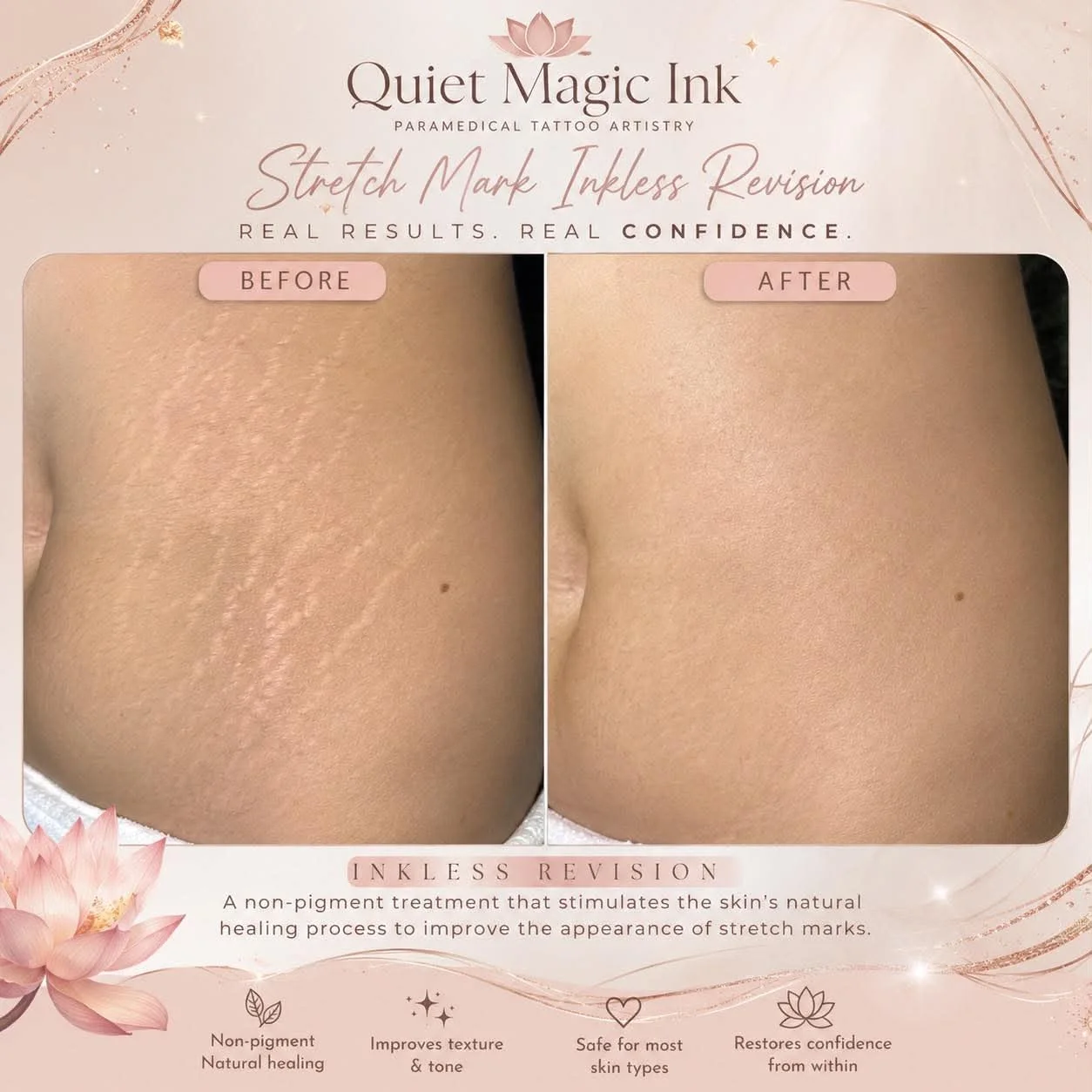 Stretch mark revision before and after result